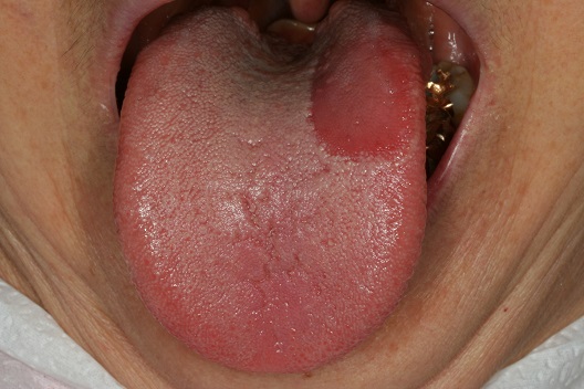구강작열감 증상을 나타내는 지도상설 환자의 사진. 지도상설(地圖狀舌, geographic tongue)은 혀의 상피가 증식하고 얼마 가지않아 그 중심부의 상피가 탈락하고, 증식부는 주위로 퍼져나가 다소 부정형의 융기된 윤상(輪狀)을 나타내며, 빠른 변화 속도를 보이는 게 특징이다.
