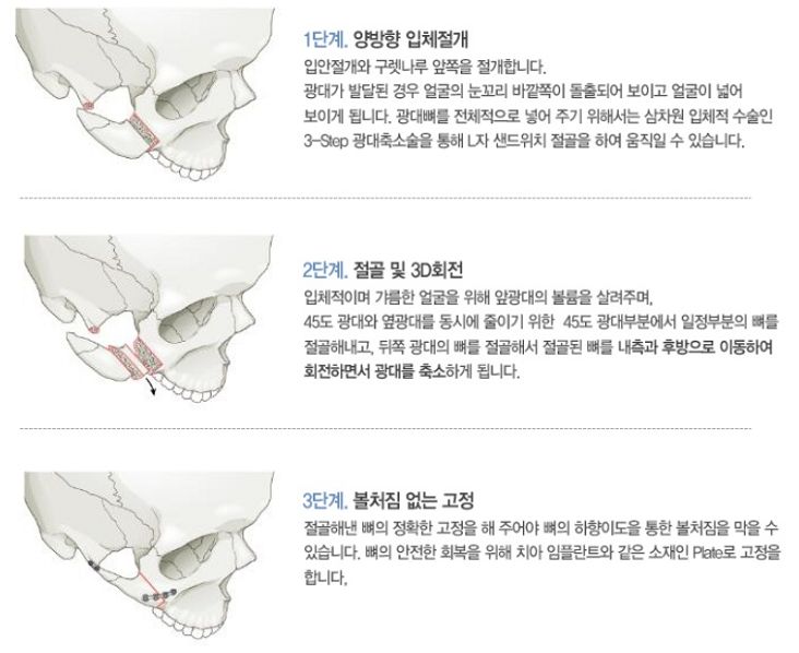 광대뼈축소수술.jpg