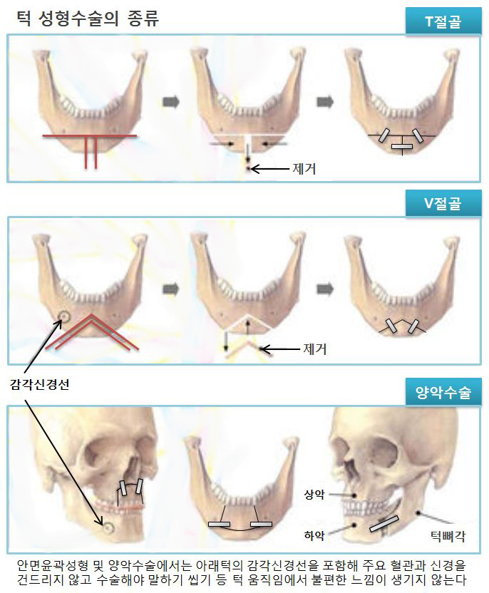 턱성형수술의종류 (2).jpg