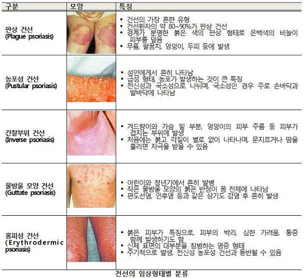 건선의 임상형태별분류.jpg