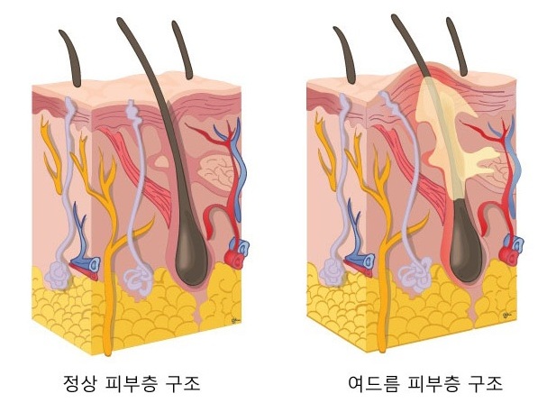 여드름+정상_23.jpg