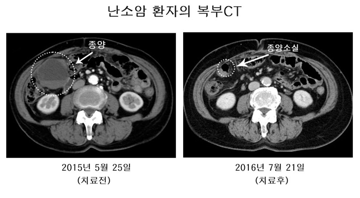 복부로 전이된 말기 난소암 환자가 다가 신수지상세포 암백신 ‘아베백스’로 치료받은 지 1년 2개월 만에 컴퓨터단층촬영(CT) 결과 종양이 소실됐다(자료 선진바이오텍 제공).