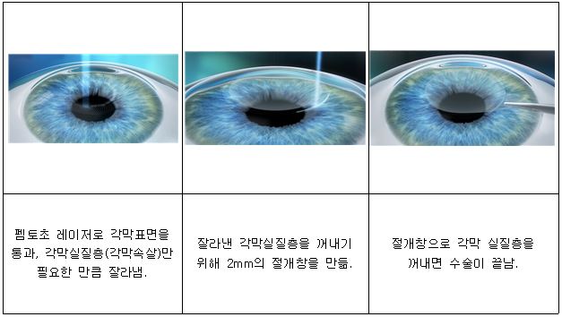 스마일(SMILE) 시력교정술 모식도