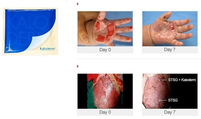 테고사이언스의 동종유래 피부재생 세포치료제인 ‘칼로덤’(왼쪽)과 화상 환자 치료 사례    