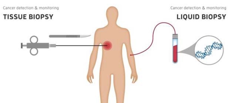 액체생검은 채혈처럼 간편하게 암유전자 돌연변이 여부를 확인할 수 있어 침습적인 조직생검보다 환자와 의료진 모두 부담이 적다(출처 나승두 SK증권 애널리스트의 ‘파나진 사업보고서’)  