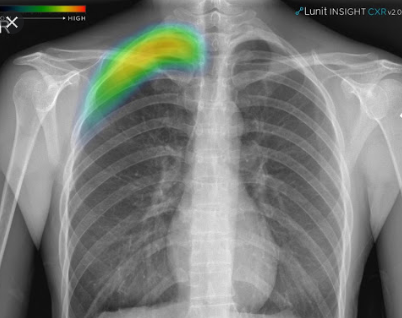 인공지능(AI) 소프트웨어 개발업체 루닛의 ‘Lunit INSIGHT CXR 2’로 검출한 기흉 진단 사례 