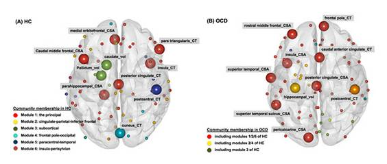 정상인(왼쪽)과 강박증 환자의 ‘뇌 구조 변이 네트워크’ 비교