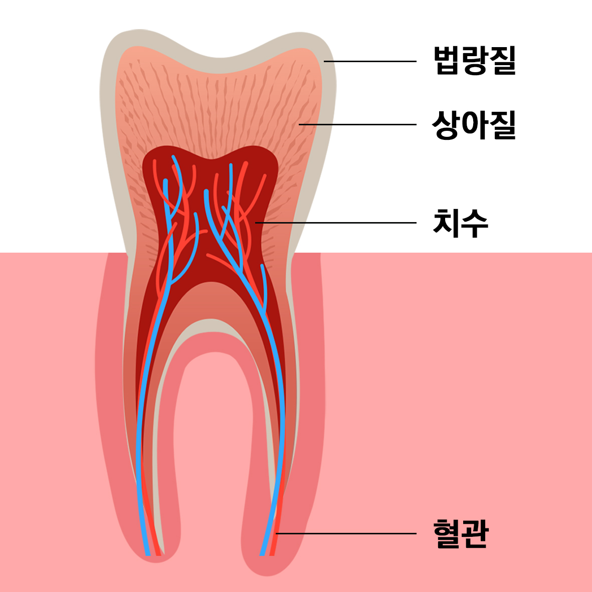 충치는 치아에 퍼진 범위에 따라 4 단계로 나눌 수 있다.