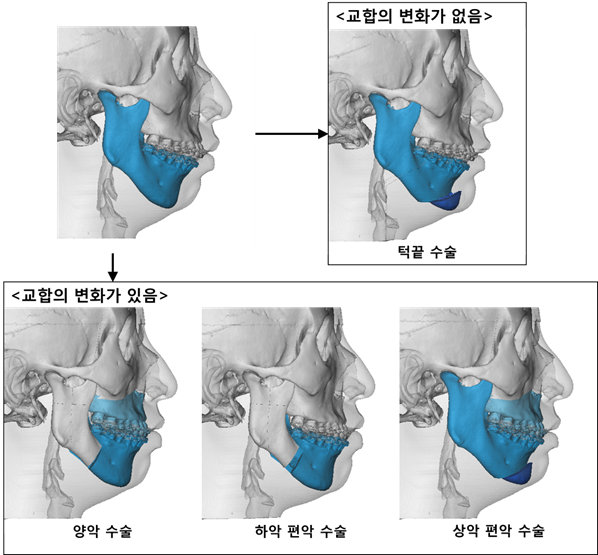 골격성 2급 부정교합(무턱)의 다양한 수술방법. 서울대치과병원 제공