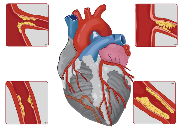 심장관상동맥이 콜레스테롤과 혈전으로 점점 막혀가는 동맥경화 과정