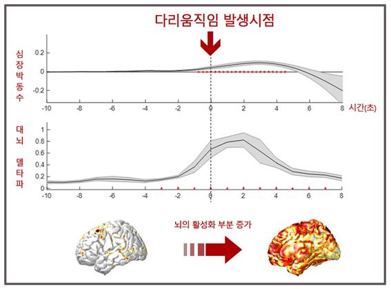 주기적사지운동증 뇌파분석 그래프, 다리가 움직이는 몇 초 전부터 대뇌가 급격히 활성화 되는 것을 확인할 수 있다.