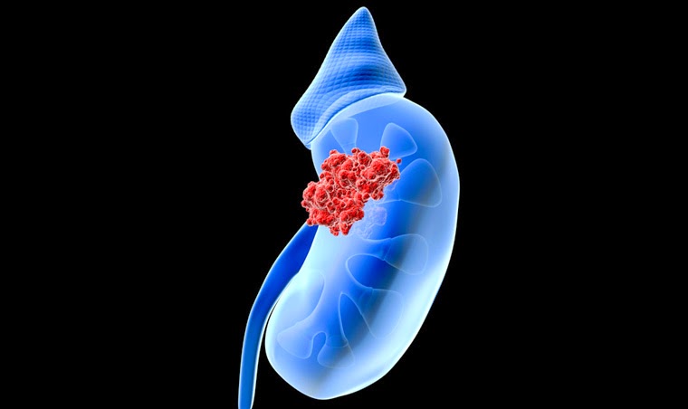 상부요로상피세포암(upper track urothelial cancer, UTUC)의 개념도