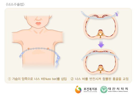 오목가슴 수술치료는 옆구리부위를 약 1cm 정도 절개 후 금속막대를 삽입해 갈비뼈를 지지대로 삼아 흉골을 들어 올리는 방식이다. 