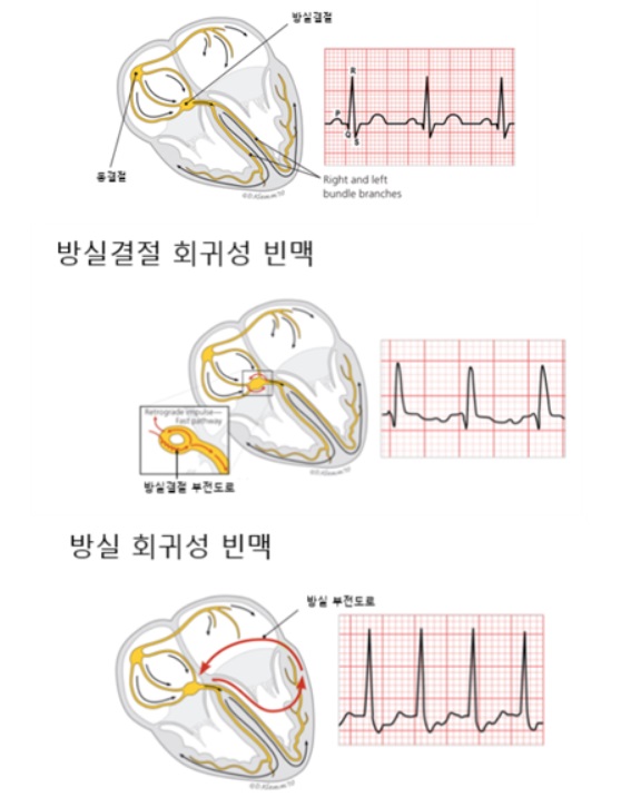 심장 정상적전도로(위에서부터) 방실결절 회귀성빈맥, 방실결절 회쉬성빈맥 그림. 가톨릭대 인천성모병원 제공