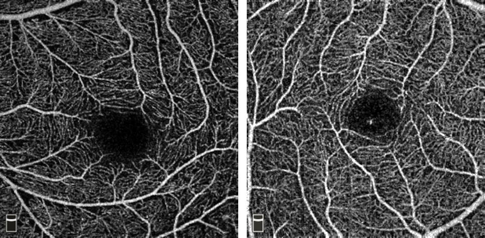 빛간섭단층촬영 혈관조영술(OCTA)을 이용한 근시안( 왼쪽)과 정상안의 황반부 망막혈관 비교 사진.