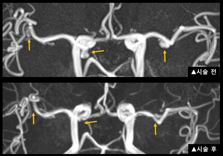 다발성 뇌동맥류 환자 황 모 씨의 시술 전후 자기공명 혈관 조영술(MRA) 영상 비교 사진