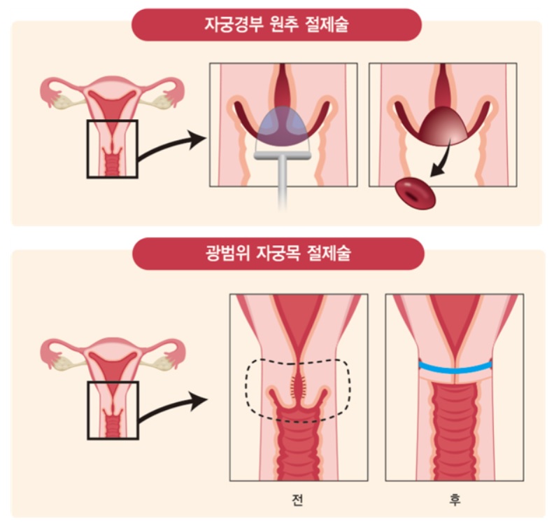 자궁경부 원추 절제술‧광범위 자궁목 절제술 그림 