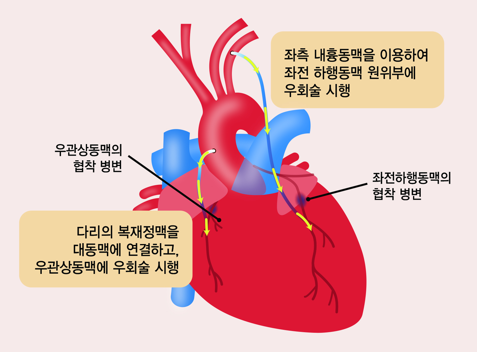 관상동맥우회술 설명 그림. 강동경의대병원 제공.