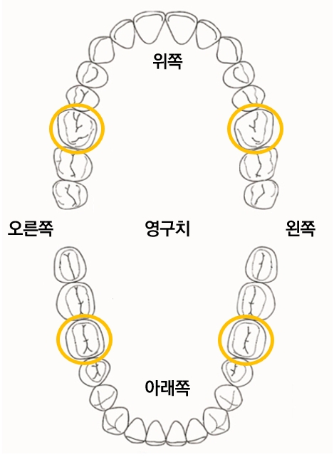 제1대구치(첫번째 큰 영구치 어금니, 총 4개)의 위치, 노란색 동그라미. 서울대치과 제공.