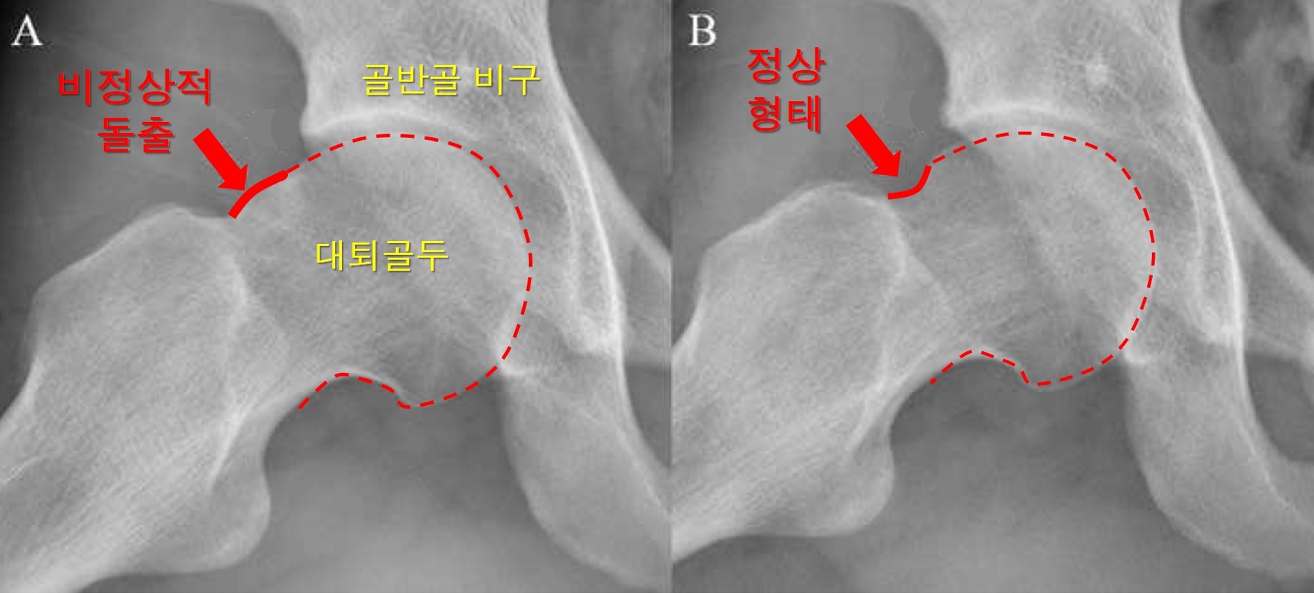  고관절 충돌증후군 환자의 관절경수술 전후 엑스선 영상. 서울아산병원 제공.