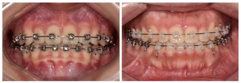 교정치료 기기 브라켓, 금속 브라켓(왼쪽)과 세라믹 브라켓