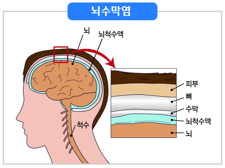 뇌수막염은 세균이나 바이러스가 뇌막에 염증을 일으키는 질환이다.