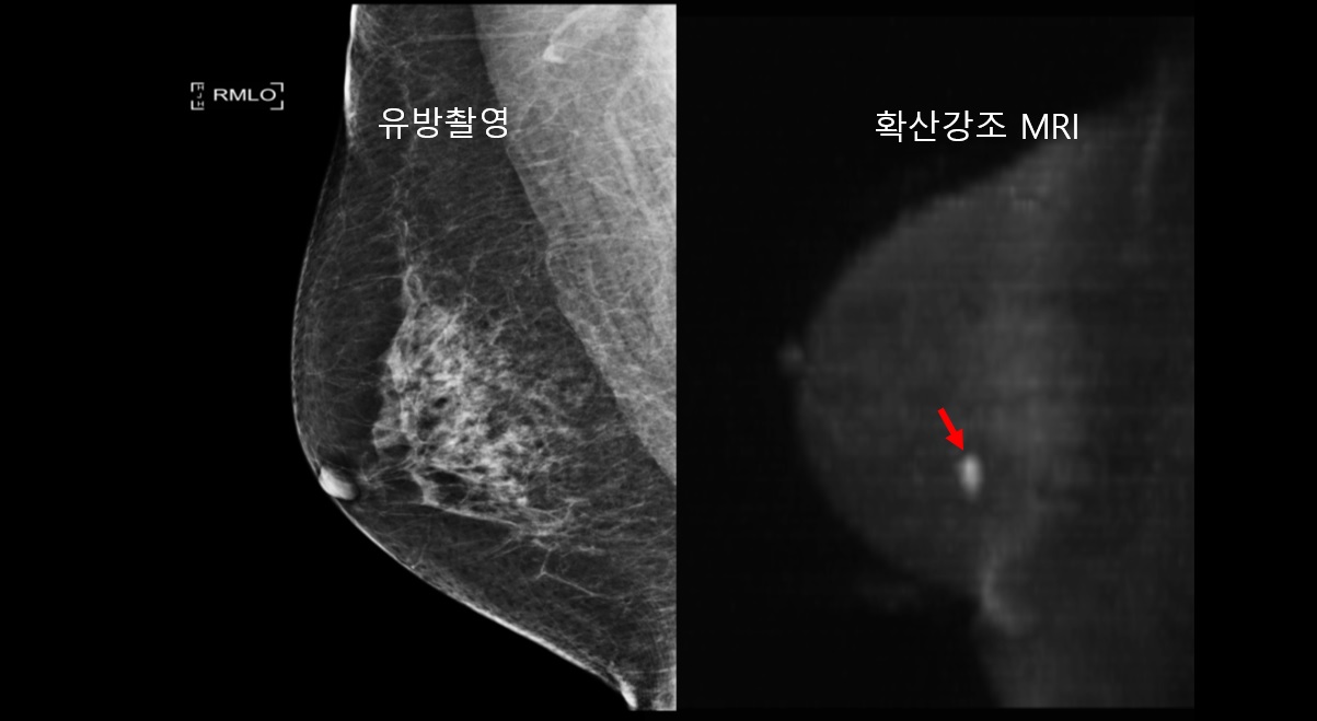 조영증강 자기공명영상검사(왼쪽)과 확산강조 자기공명영상검사