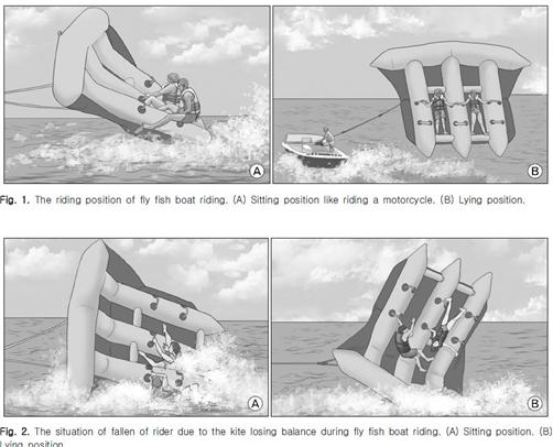 플라이 피쉬를 타면 수술을 요하는 상완골(어깨와 팔꿈치 관절 사이의 뼈) 골절 위험이 높은 것으로 나타났다.
