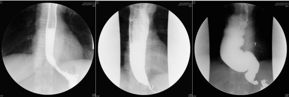 정상적인 식도(왼쪽부터), 일반적인 식도 아칼라지아, 진행성 식도 아칼라지아.