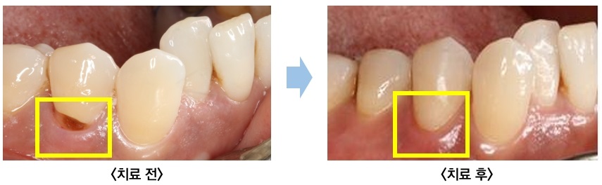 앞니에 발생한 치경부 마모증을 복합레진으로 치료한 전·후 모습