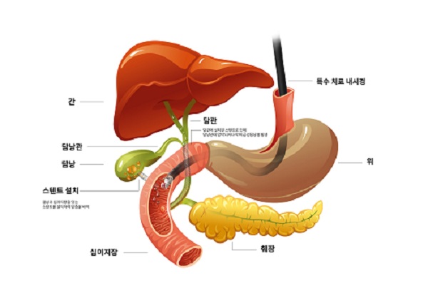 ‘초음파내시경 유도 담낭배액술(EUS-GBD)’ 모식도