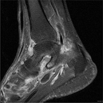 발목관절 자기공명영상(MRI) 촬영사진