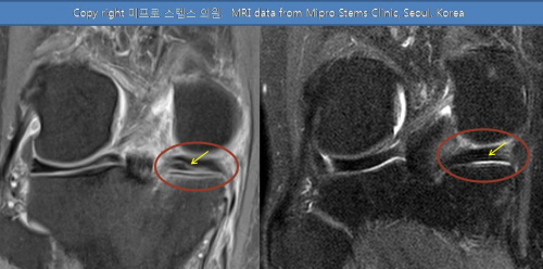 53세 반월상연골판파열 환자의 줄기세포치료 전(왼쪽)과 치료 12개월 뒤 무릎 MRI 비교사진