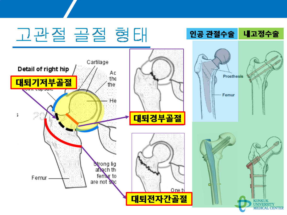 고관절 골절의 형태