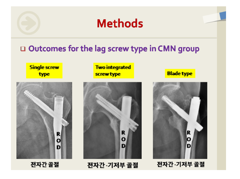 고관절 골절 형태에 따른 고정나사 사용