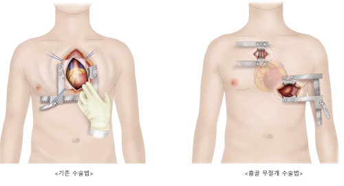 흉골 무절개 방식 인공심장 이식수술(오른쪽)과 기존 수술 비교 모식도