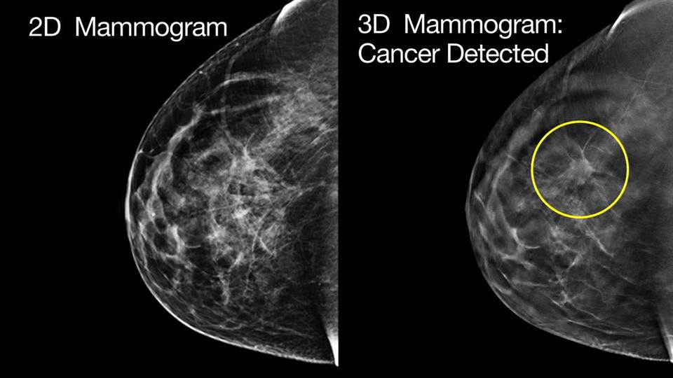 기존 유방촬영검사(2D)와 최근 부상 중인 3D 유방촬영검사의 유방암 영상진단