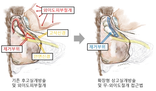 이준호 한림대 춘천성심병원 이비인후과 교수가 개발한 만성 중이염 수술법 ‘확장형 상고실개방술 및 무외이도절개 접근법’ 모식도 