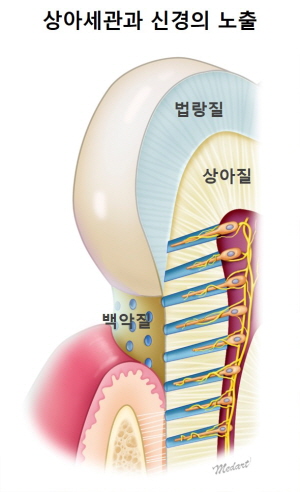 치아의 상아질이 노출되면 상아세관과 신경이 외부로 드러나 온도나 압력 등 외부자극에 민감해져 시린이 증상이 나타날 수 있다.