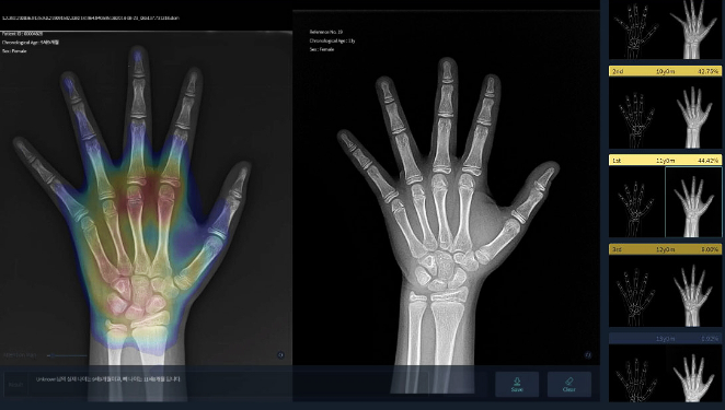 AI 의료기기 스타트업 뷰노가 개발한 ‘뷰노메드 본에이지’로 측정한 뼈나이 진단결과 화면