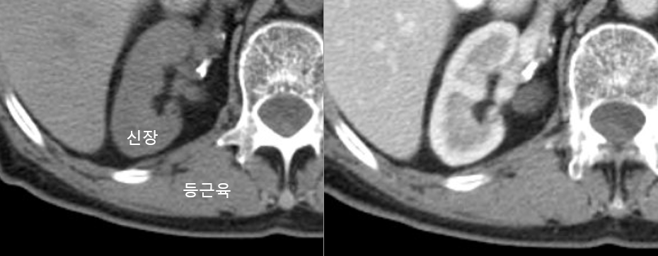 비조영증강 CT(왼쪽), 조영증강 CT