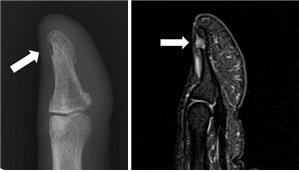 사구체종양 MRI 사진