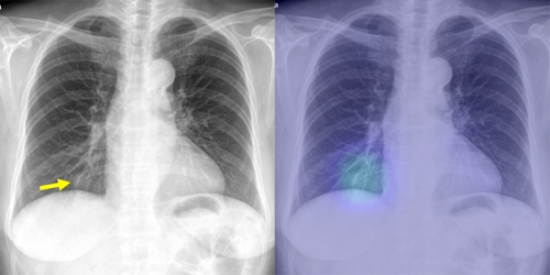 일반 흉부 X-레이 사진(왼쪽)과 인공지능 진단보조시스템이 확인한 사진