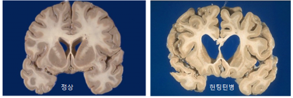 정상인과 헌팅턴병의 비교