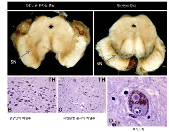 정상인과 파킨슨병환자의 중뇌비교