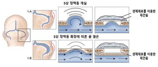 S상 정맥동 게실 이상으로 시행한 재건술 방법 (1-A), S상 정맥동 확장에 따른 골 결손 이상으로 시행한 재건술 방법(1-B) 