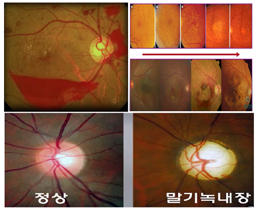 당뇨병성 망막증(왼쪽 위부터), 황반변성진행과정, 녹내장