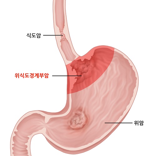 위식도경계부암(선암)의 발생 위치