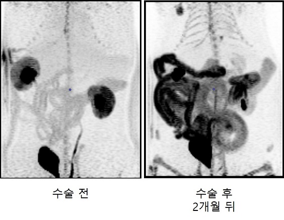 고도 비만 및 당뇨병 동물 실험에서도 혈액 안에 과다하게 존재하는 포도당이 비만대사 수술 후 소장을 통해 대변으로 배출되는 것을 확인했다.