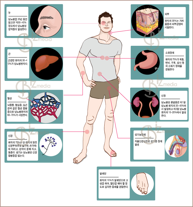 당뇨병 합병증